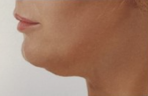 Double chin