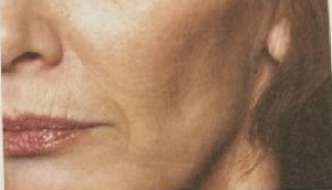 Flattened/sunken cheeks