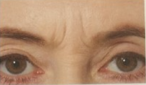 Frown Lines (Between brows)