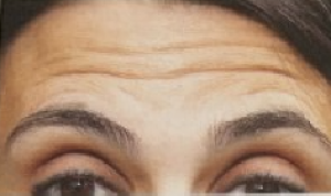 Forehead Lines