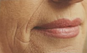 Lines and wrinkles around the nose and mouth