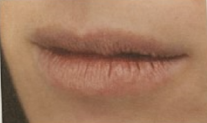 Appearance of  lips
