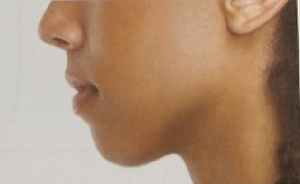 Small chin/weak chin profile
