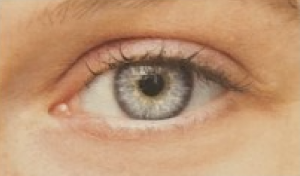 Thinning or inadequate lashes