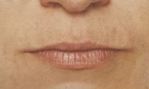 Thin lips